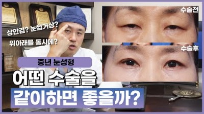 상안검수술, 눈썹하거상술, 하안검수술 중년눈성형 자연스럽게 잘하는 방법 - 강남 신사동 모티브성형외과 제공