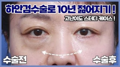 중년눈성형,10년 젊게 보이는 지방 재배치 및 하안검 수술 정보[강남구 신사동 모티브성형외과]