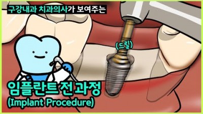 임플란트 수술 총 과정 임프란트 구성(인공치근, 지대주,인공치아), 식립 과정 및 종류 기구 까지 임프란트 총정리